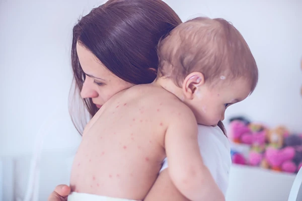 Image for article titled Chicken Pox